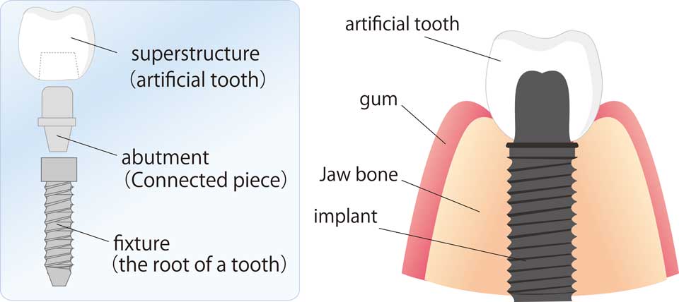 dental-implants-blog-post-00402